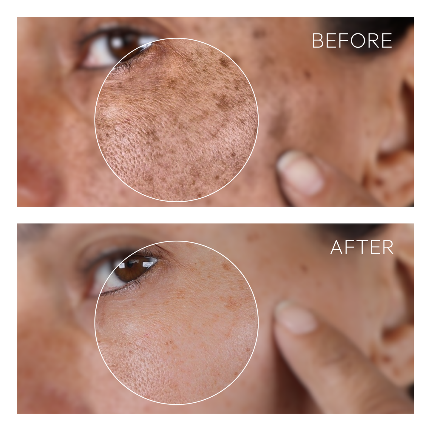Clinical Hyperpigmentation Treatment Set