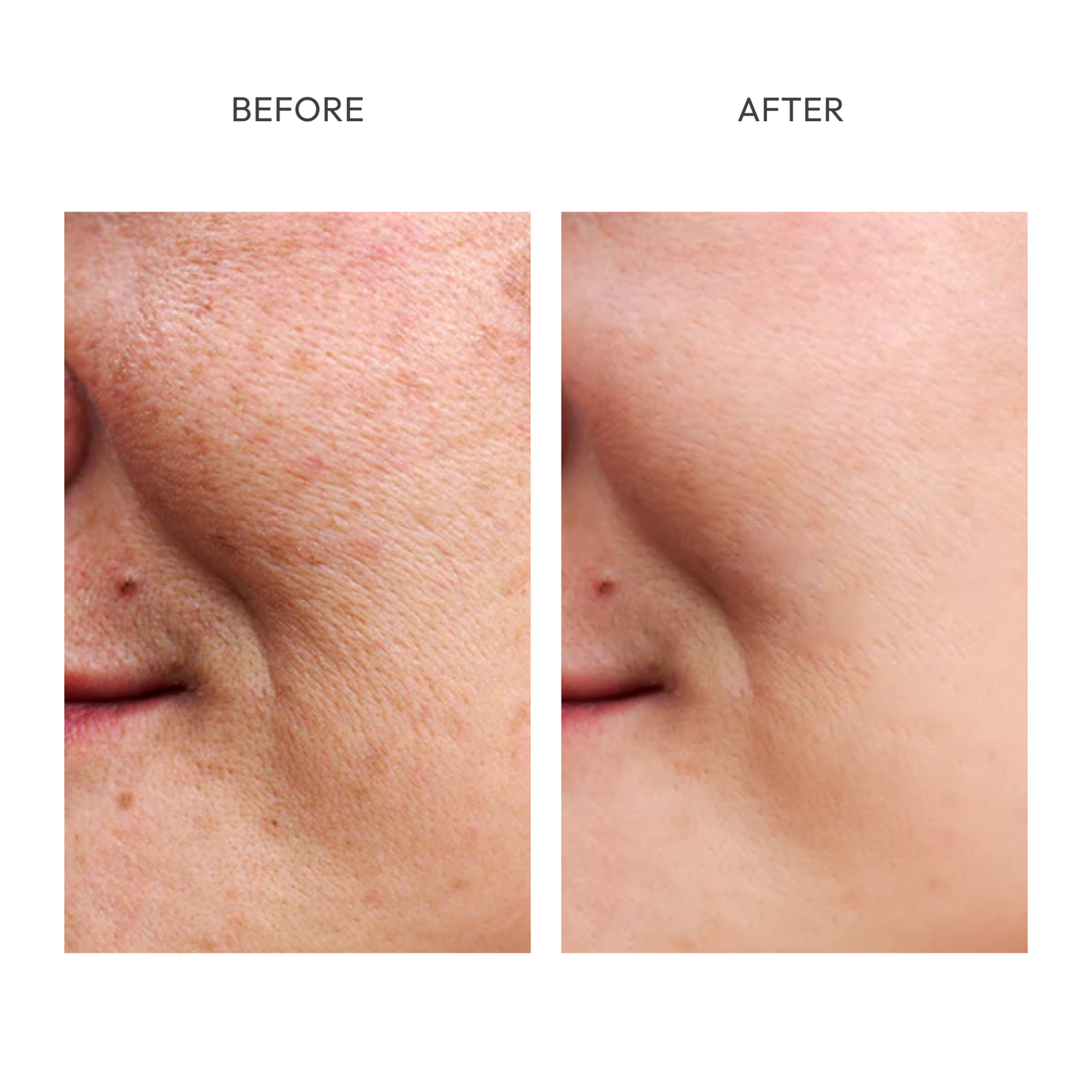 Clinical Hyperpigmentation Treatment Set